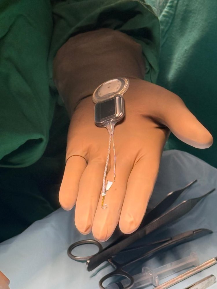 15 महीने की बच्ची को मिला दुनिया का पहला Nexa Smart Cochlear Implant